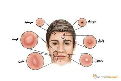 انواع جوش صورت