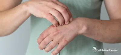 نحوه تشخیص اگزما