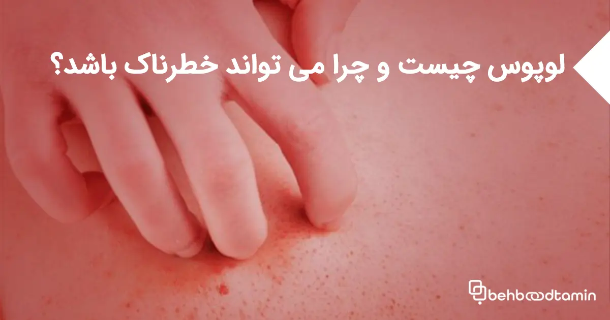 لوپوس چیست و چرا می تواند خطرناک باشد؟
