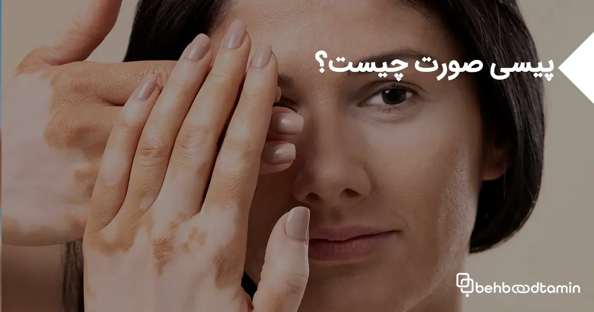 پیسی صورت چیست؟ توضیحات علمی درباره این مشکل پوستی