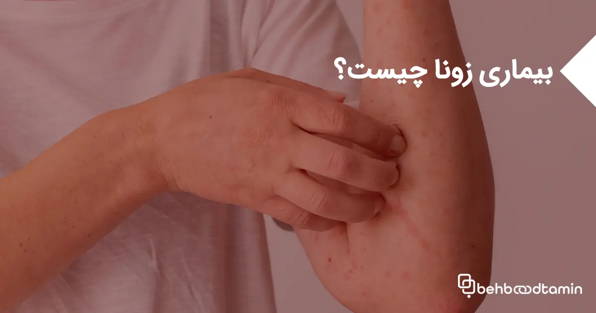 بیماری زونا چیست؟