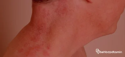 علل درماتیت عصبی