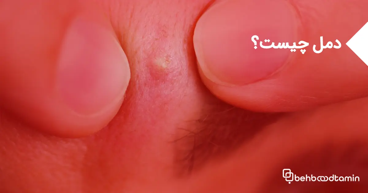 دمل چیست؟