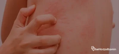 ویژگی های بالینی سوزش عصبی پوست