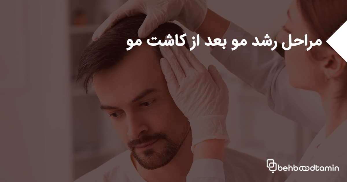 مراحل رشد مو بعد از کاشت مو