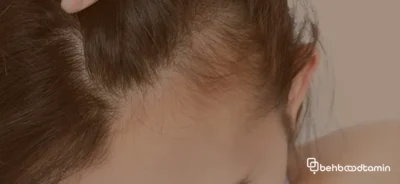 دلایل کم پشتی مو