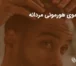 ریزش موی هورمونی مردانه