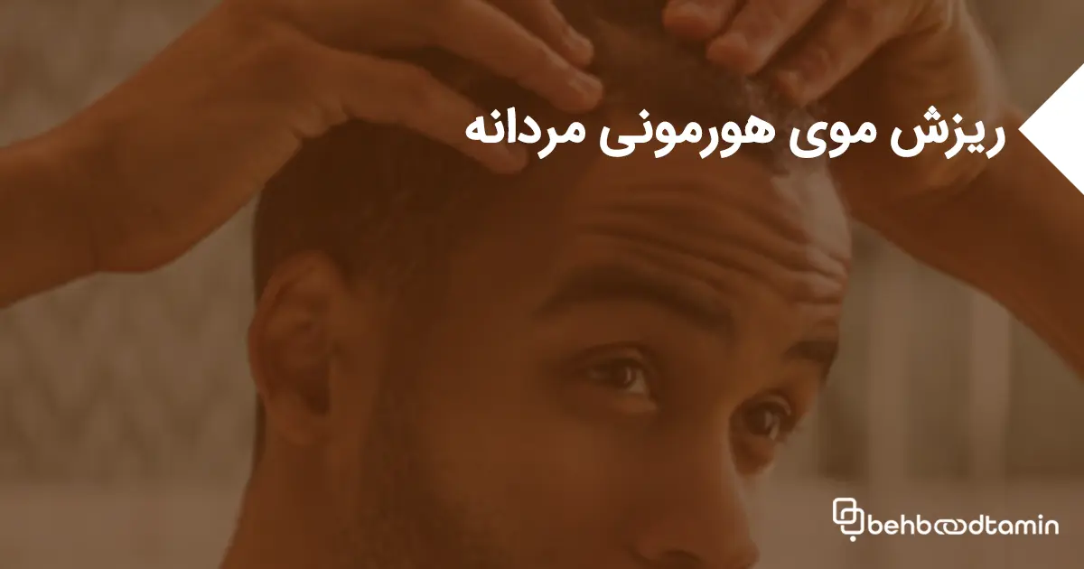 ریزش موی هورمونی مردانه