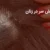 علائم شپش سر در زنان