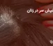 علائم شپش سر در زنان