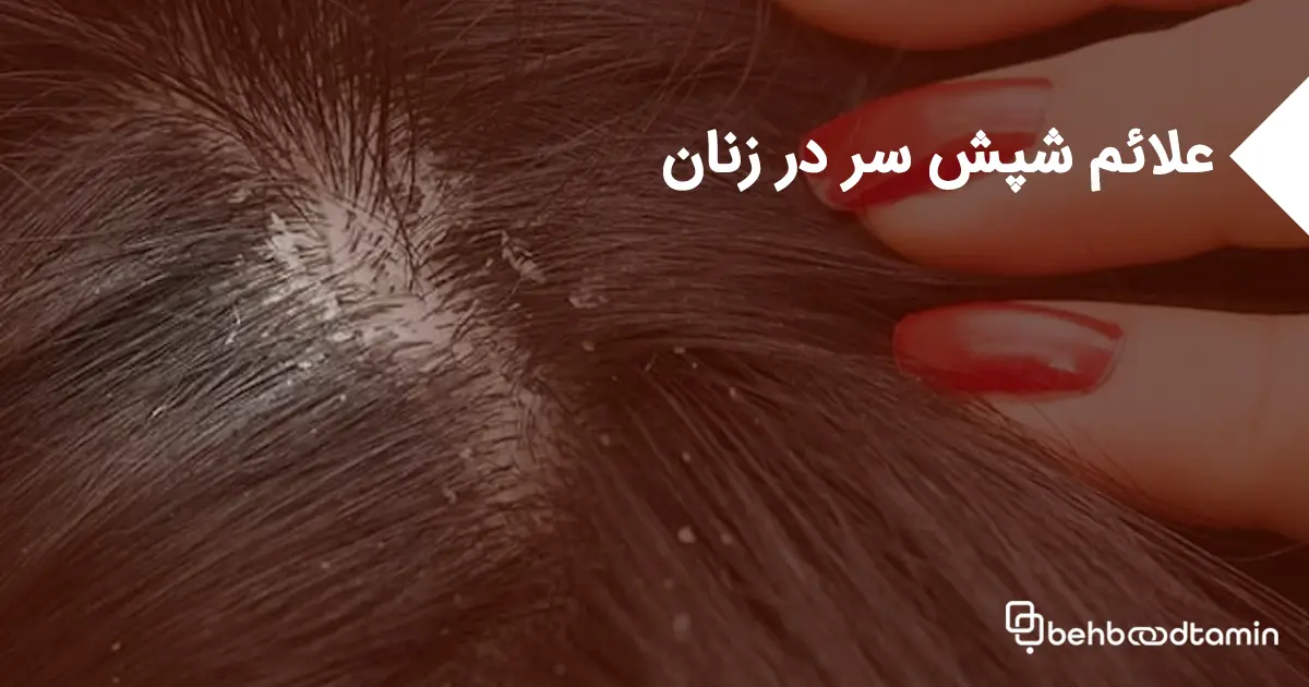 علائم شپش سر در زنان