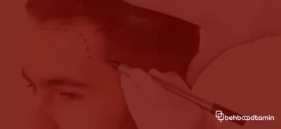 ممنوعیات بعد از کاشت مو