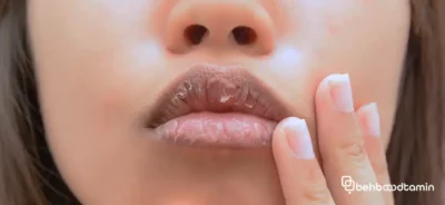 دلایل خشکی لب