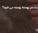 چرا پوست سر پوسته پوسته می شود؟