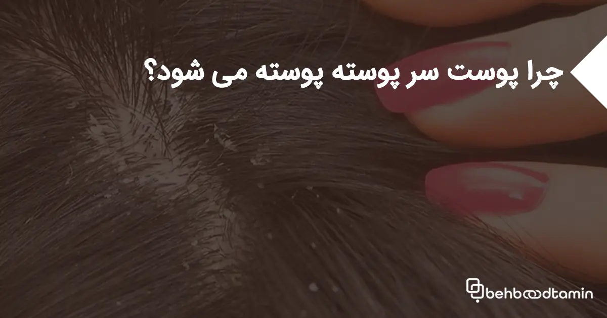 چرا پوست سر پوسته پوسته می شود؟