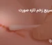 درمان سریع زخم تازه صورت
