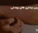 شایع ترین بیماری‌های پوستی