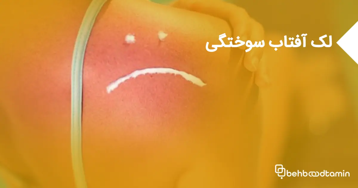 لک آفتاب سوختگی