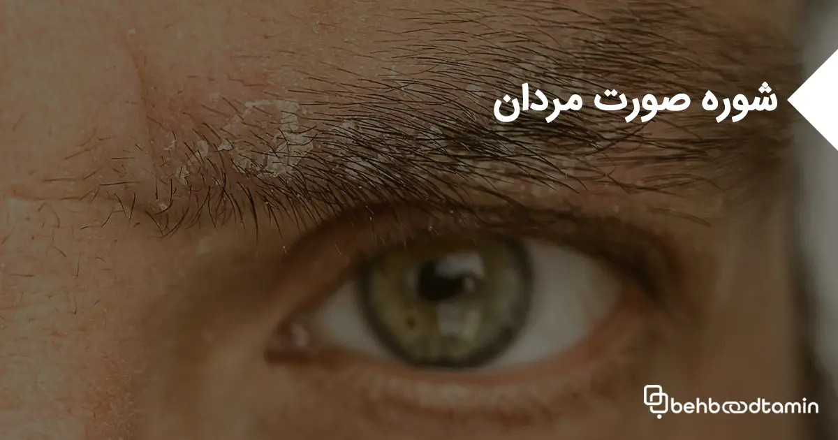 شوره صورت مردان