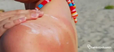 آفتاب سوختگی 