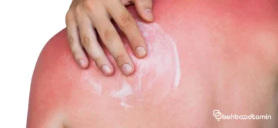 لک آفتاب سوختگی چیست؟