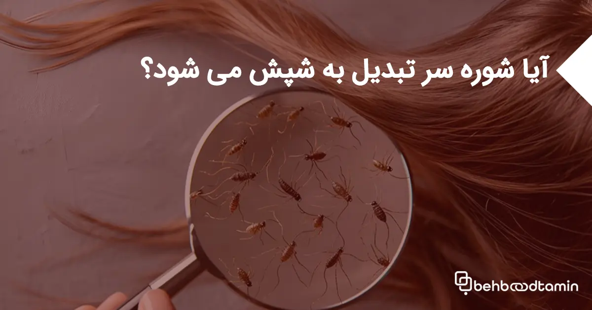 آیا شوره سر تبدیل به شپش می شود؟
