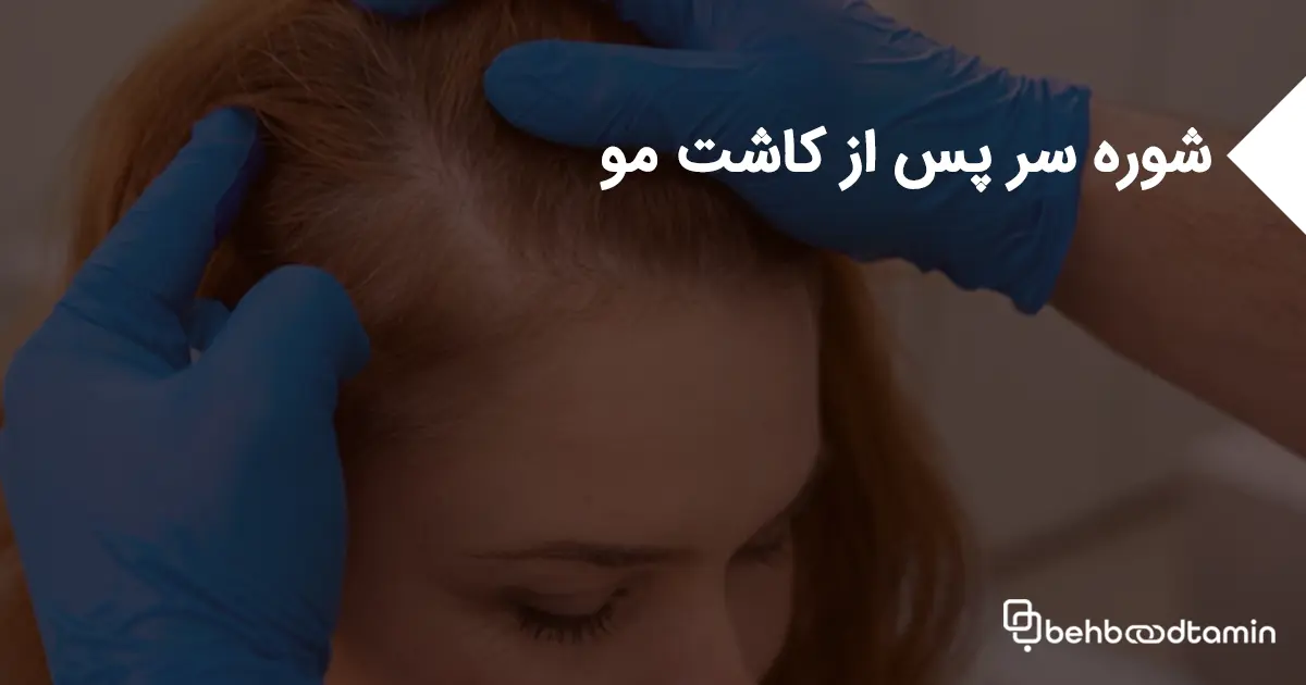 شوره سر پس از کاشت مو