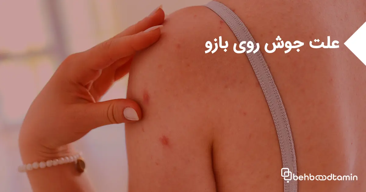 علت جوش روی بازو