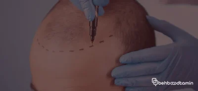 دلایل شوره سر پس از کاشت مو