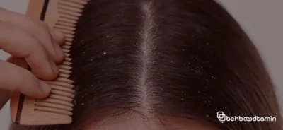 شپش سر چیست؟