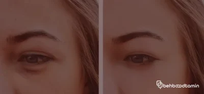 راهکار های پزشکی برای کاهش سیاهی زیر چشم