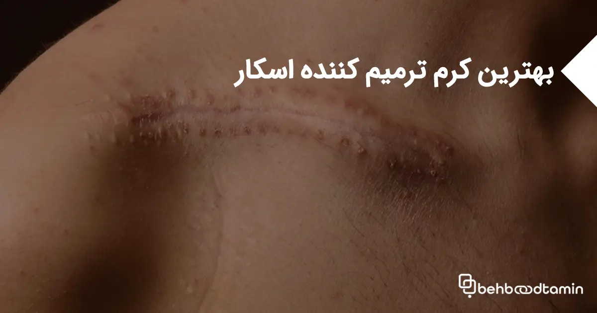 بهترین کرم ترمیم کننده اسکار