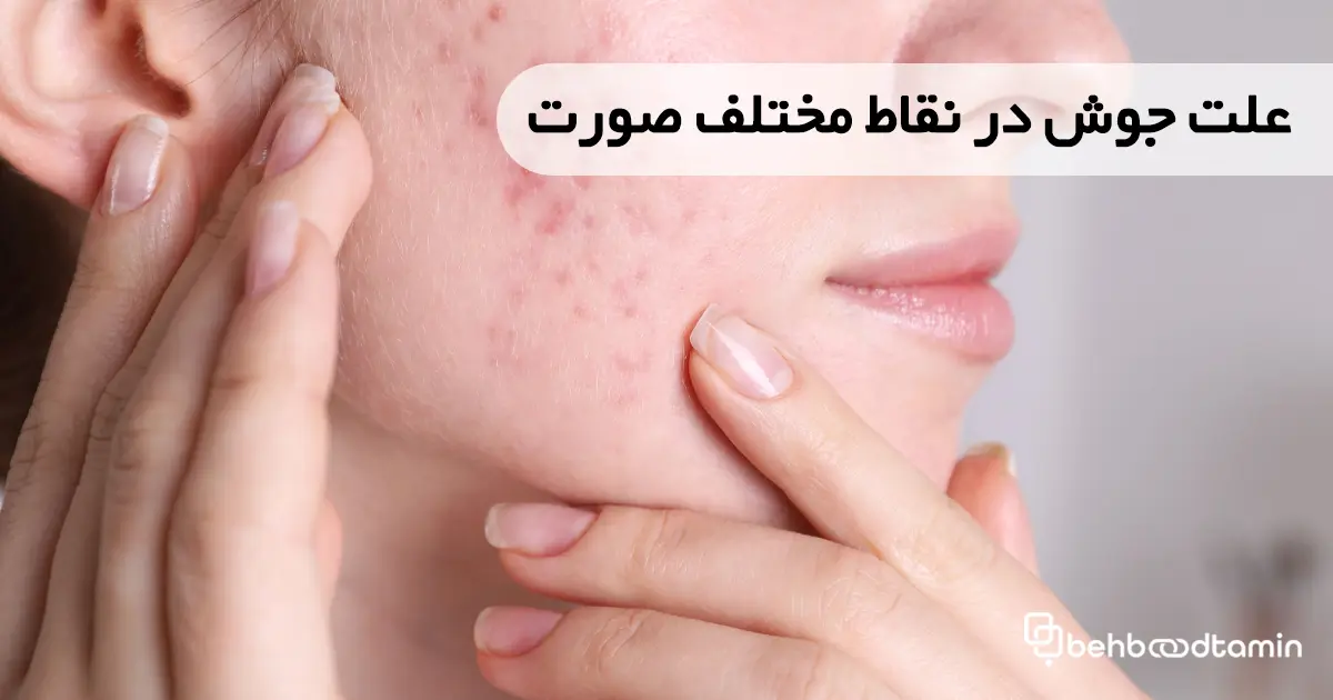 علت جوش در نقاط مختلف صورت