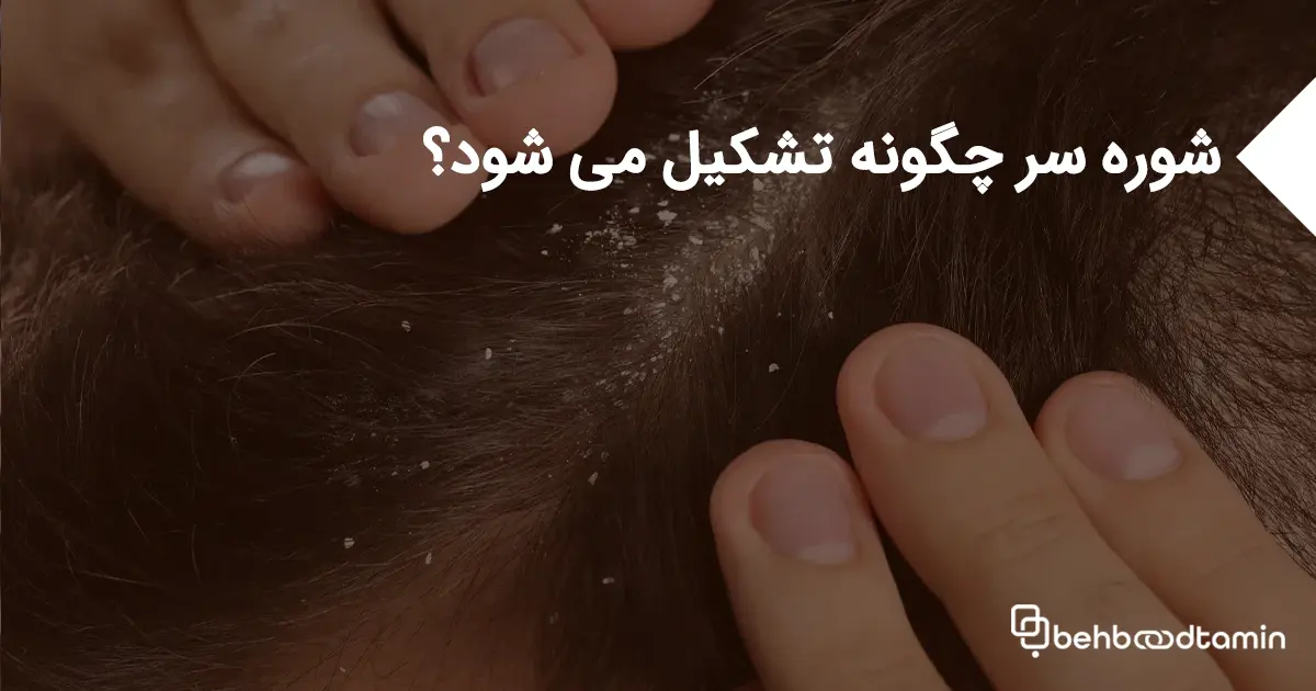 شوره سر چگونه تشکیل می شود؟