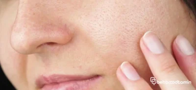 ویژگی های مهم سرم برای منافذ باز پوست