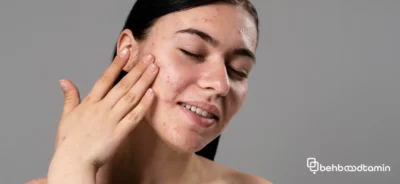 جوش در نقاط مختلف صورت