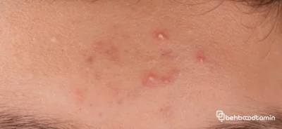 جوش در نقاط مختلف صورت