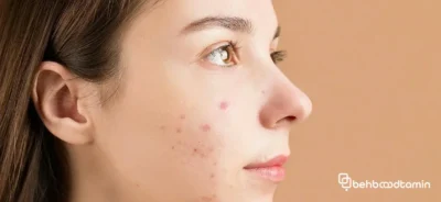 ویژگی های سرم ضد جوش