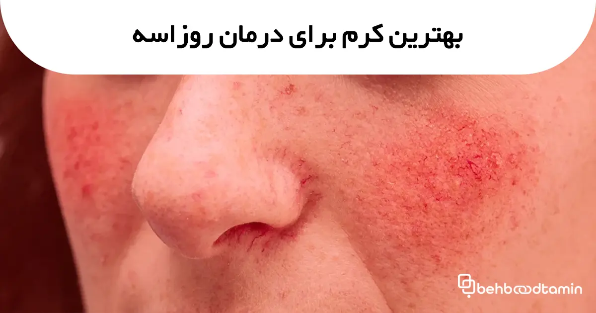 بهترین کرم برای درمان روزاسه
