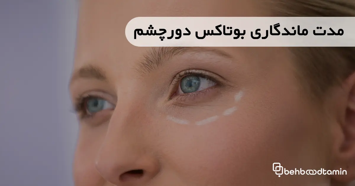 مدت ماندگاری بوتاکس دور چشم