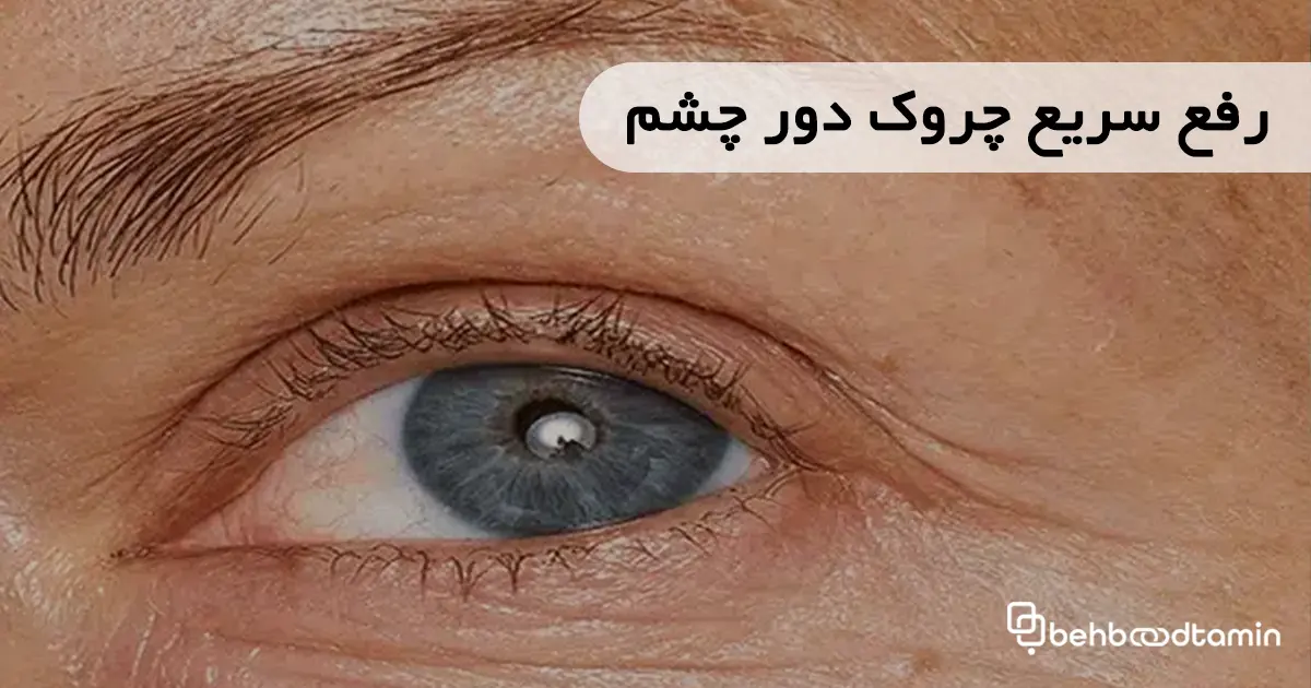 رفع سریع چروک دور چشم