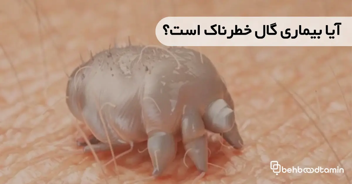 آیا بیماری گال خطرناک است؟