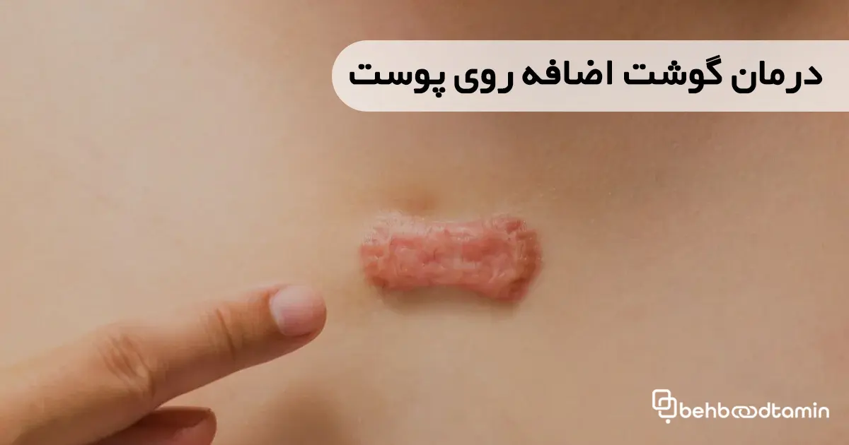 درمان گوشت اضافه روی پوست