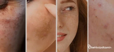 انواع لک های پوستی