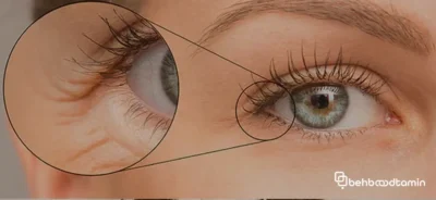 دلایل چروک دور چشم