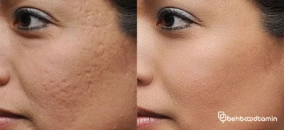 مزایای سابسیژن