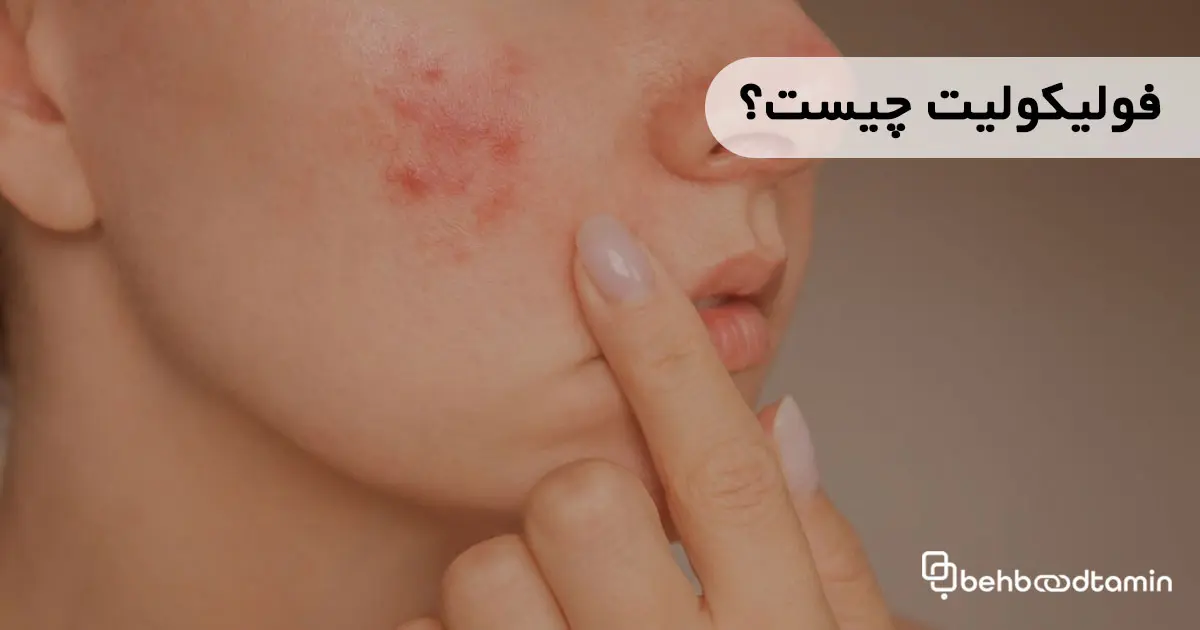 فولیکولیت چیست؟