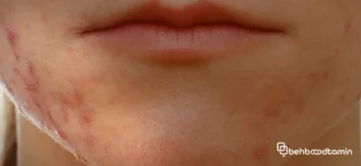 علل ایجاد فولیکولیت