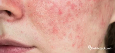 علل شایع لکه های قرمز روی پوست