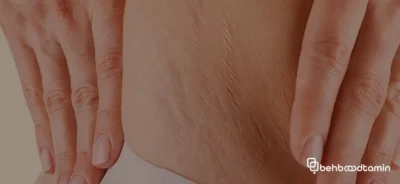 انواع استرچ مارک
